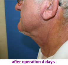 plastic-surgery-neck-lift