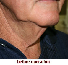 plastic-surgery-neck-lift