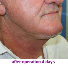 plastic-surgery-neck-lift