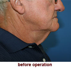 plastic-surgery-neck-lift