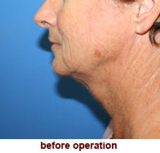 plastic-surgery-neck-lift