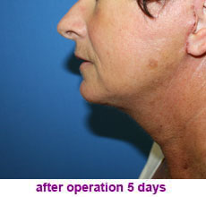 plastic-surgery-neck-lift