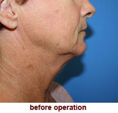 plastic-surgery-neck-lift