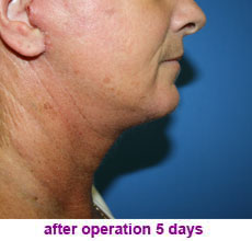 plastic-surgery-neck-lift