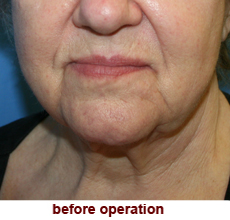 plastic-surgery-neck-lift