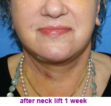 plastic-surgery-neck-lift