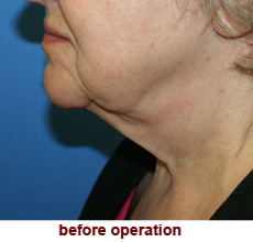 plastic-surgery-neck-lift