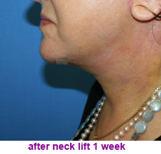 plastic-surgery-neck-lift