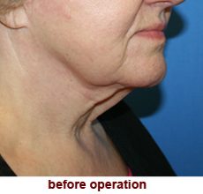 plastic-surgery-neck-lift
