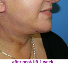 plastic-surgery-neck-lift