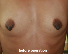 plastic_surgery_nipple_reduction