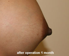 plastic_surgery_nipple_reduction