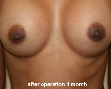 plastic_surgery_nipple_reduction