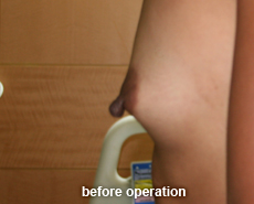 plastic_surgery_nipple_reduction