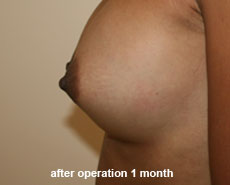 plastic_surgery_nipple_reduction