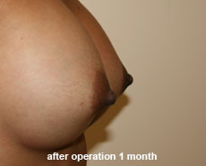 plastic_surgery_nipple_reduction