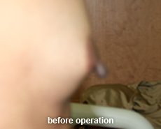 plastic_surgery_nipple_reduction