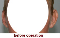 plastic-surgery-otoplasty 