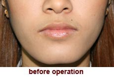 plastic-surgery-smile-dimple