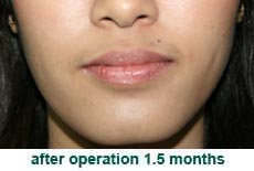 plastic-surgery-smile-dimple