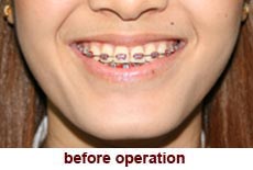 plastic-surgery-smile-dimple