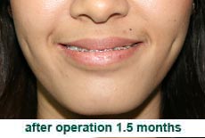 plastic-surgery-smile-dimple