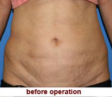 plastic-surgery-tummy-tuck
