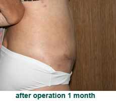 plastic-surgery-tummy-tuck