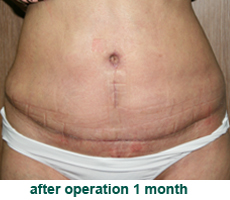 plastic-surgery-tummy-tuck