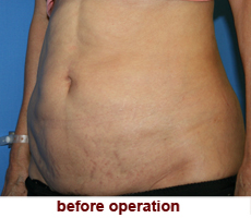 plastic-surgery-tummy-tuck