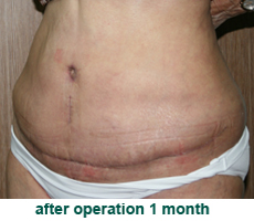 plastic-surgery-tummy-tuck