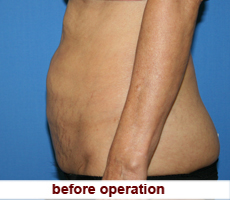 plastic-surgery-tummy-tuck
