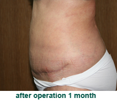 plastic-surgery-tummy-tuck