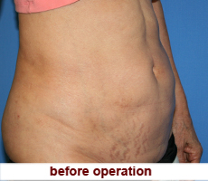 plastic-surgery-tummy-tuck