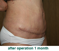 plastic-surgery-tummy-tuck
