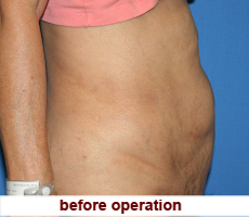 plastic-surgery-tummy-tuck