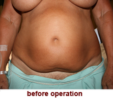 plastic-surgery-tummy-tuck