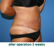 plastic-surgery-tummy-tuck