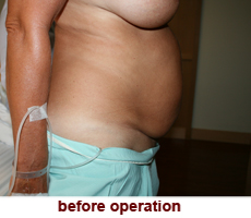 plastic-surgery-tummy-tuck