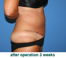 plastic-surgery-tummy-tuck