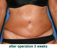plastic-surgery-tummy-tuck