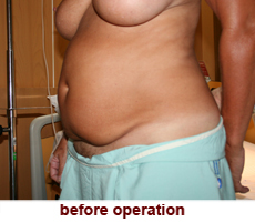 plastic-surgery-tummy-tuck