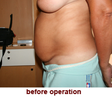 plastic-surgery-tummy-tuck