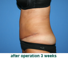 plastic-surgery-tummy-tuck