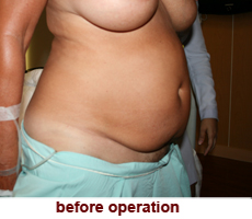 plastic-surgery-tummy-tuck