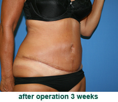 plastic-surgery-tummy-tuck