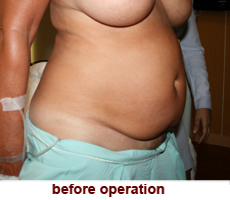 plastic-surgery-tummy-tuck