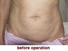 plastic-surgery-tummy-tuck
