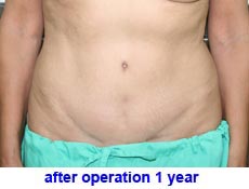 plastic-surgery-tummy-tuck