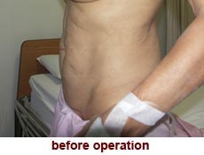 plastic-surgery-tummy-tuck